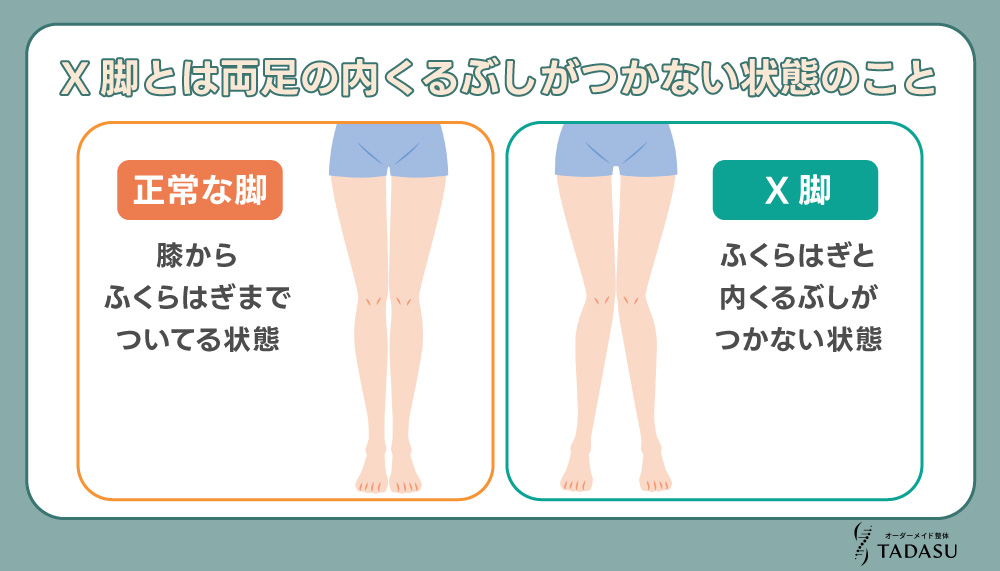 X脚とは両足の内くるぶしがつかない状態のこと