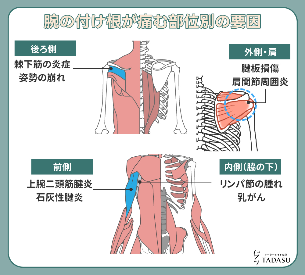 腕の付け根が痛む部位別の要因