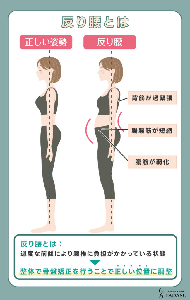 反り腰とは